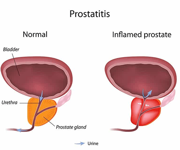 رسم توضيحي يوضح التهاب البروستاتا