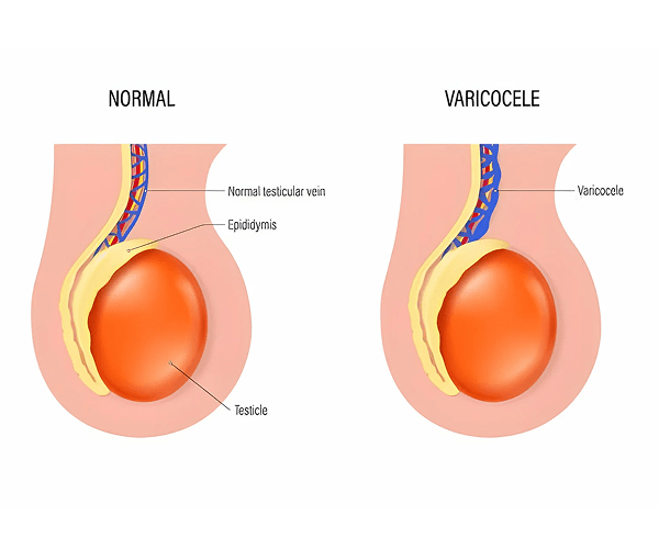 دوالي الخصية والعقم