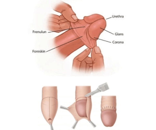 عملية الختان - دبي - الإمارات