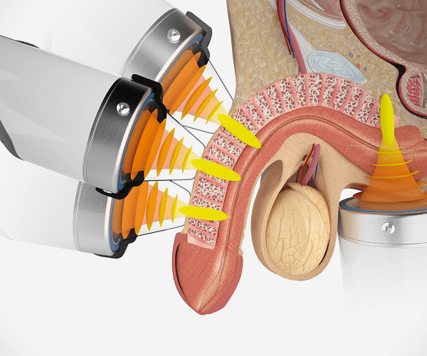 العلاج بالموجات الصدمية لضعف الانتصاب - فوائد وأضرار