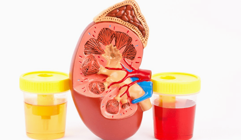 Hematuria- دم فى البول