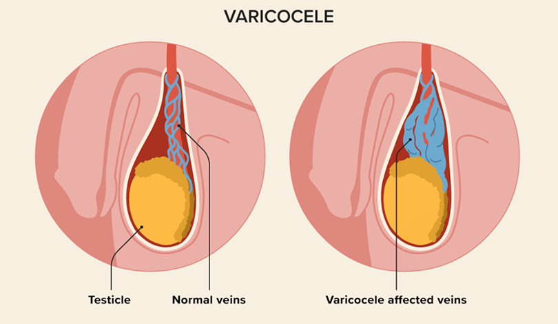 Varicocele treatment