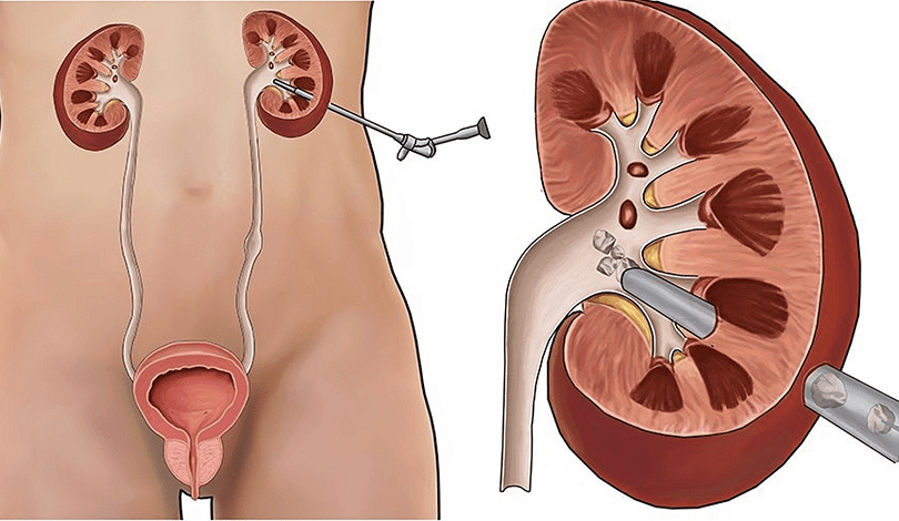 علاج حصوات الكلى بالمنظار في دبي