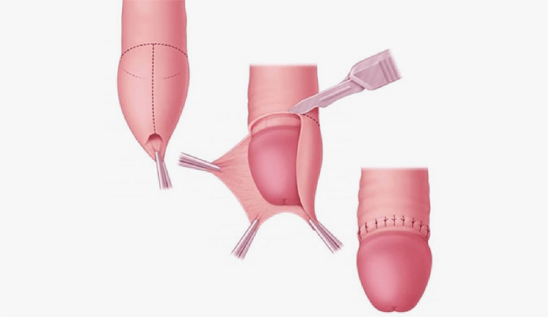 Circumcision in Dubai