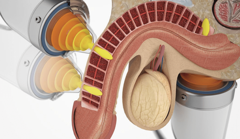 Erectile Dysfunction (ED)