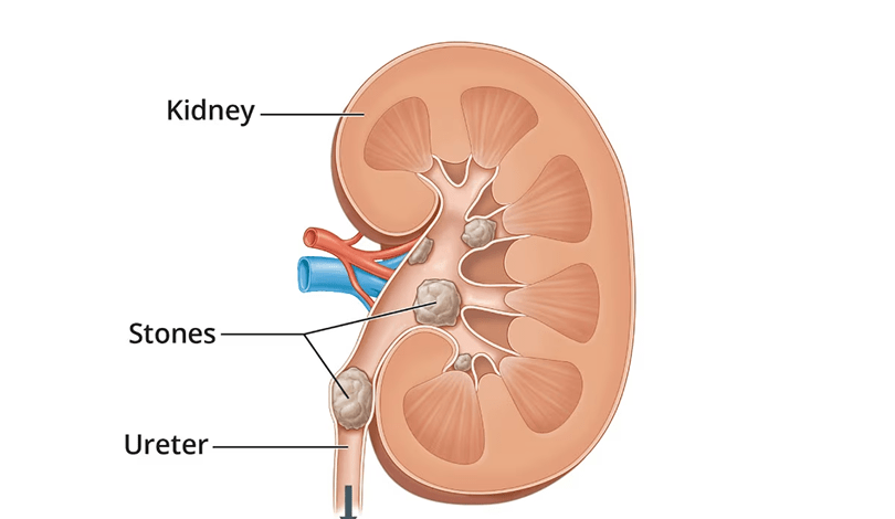 Kidney and urinary tract stones