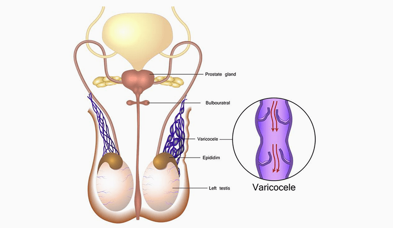 رسم توضيحي لعملية ربط دوالي الخصية بالميكروسكوب الجراحي