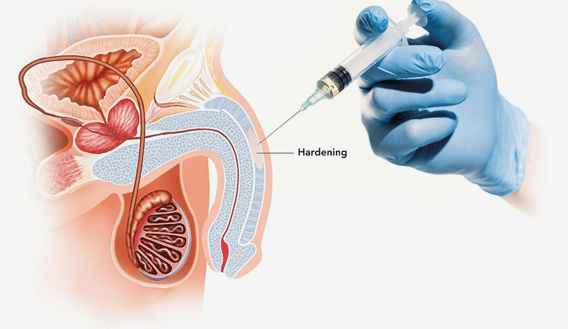 Penile Curvature Correction
