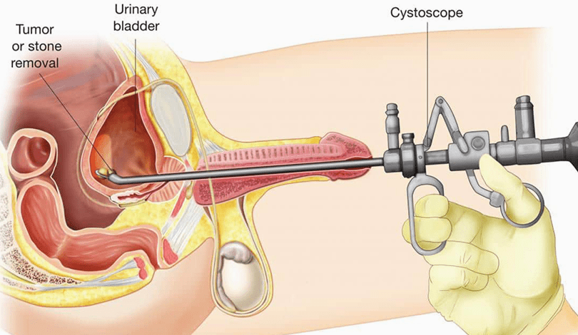 Laparoscopic/Endoscopic Management of Urinary Disease