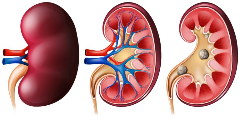 kidney stone treatment