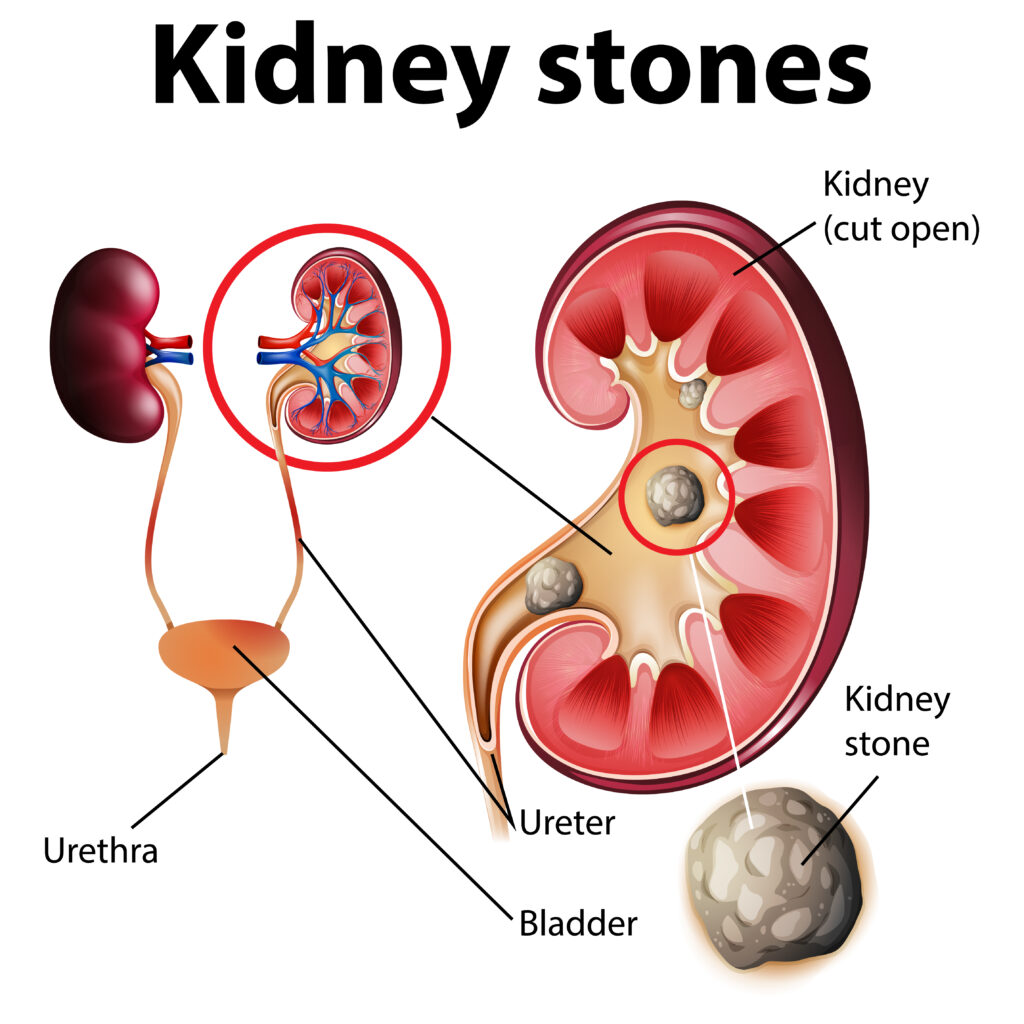 Kidney stone treatment in dubai