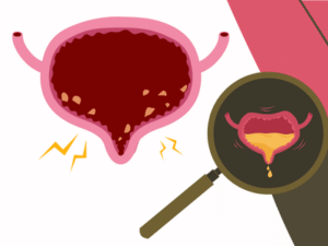 اعراض الحصوة في المثانة