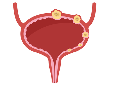 مراحل سرطان المثانة